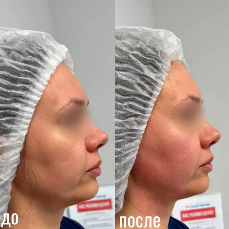 Фотография до и после с проведенной ютимс терапии в Волгограде в клинике Олимп