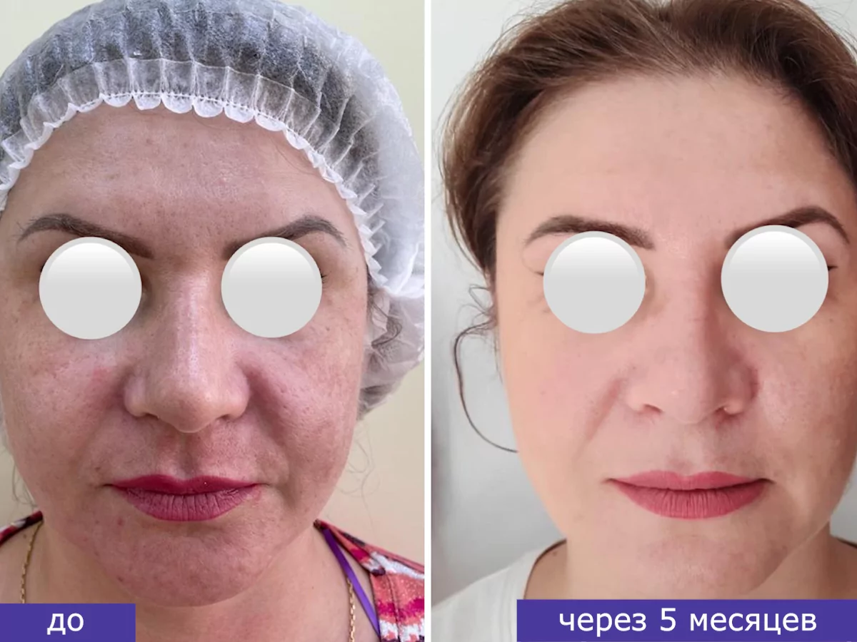 Фотография до и после альтера-терапии в Волгограде