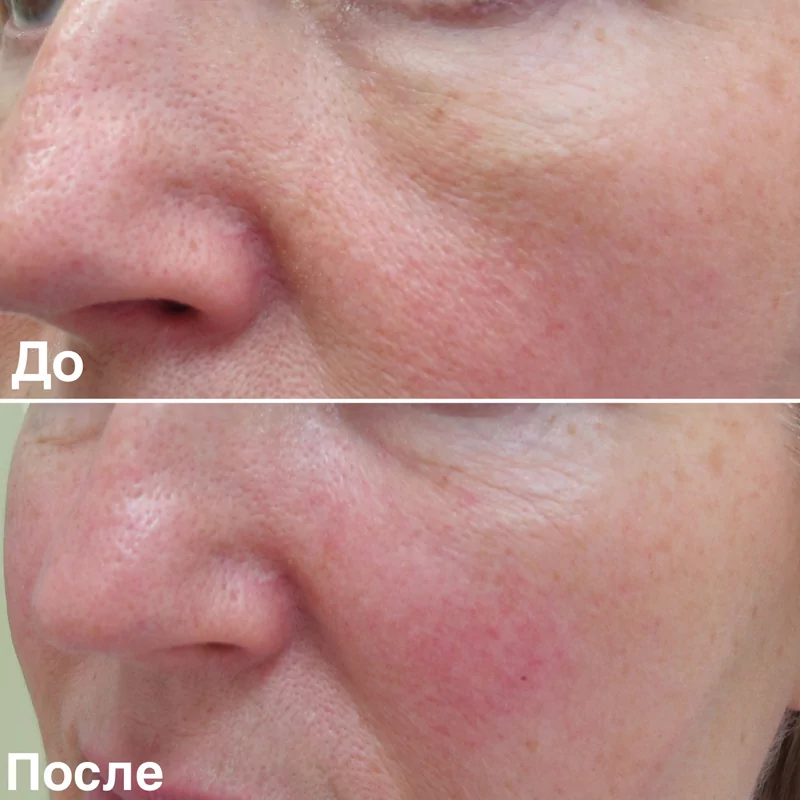 Фотография до и после с проведенной процедуры контурная пластика средней трети лица в Волгограде в клинике Олимп
