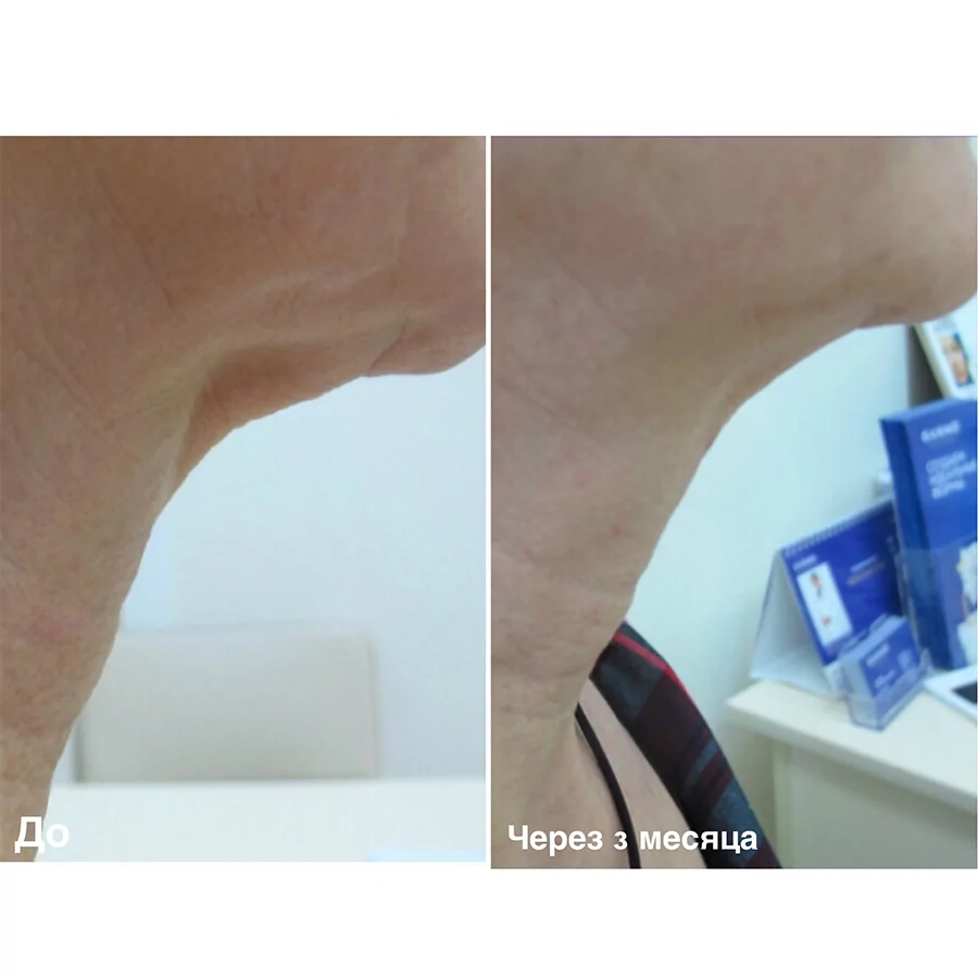 Лазерная шлифовка кожи шеи + ботулинотерапия