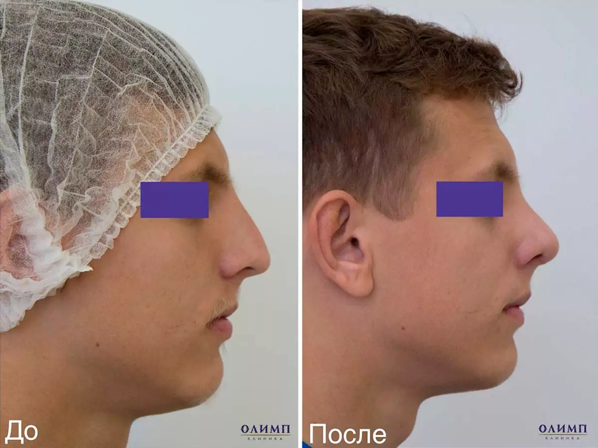 фото до и после проведения операции ринопластика