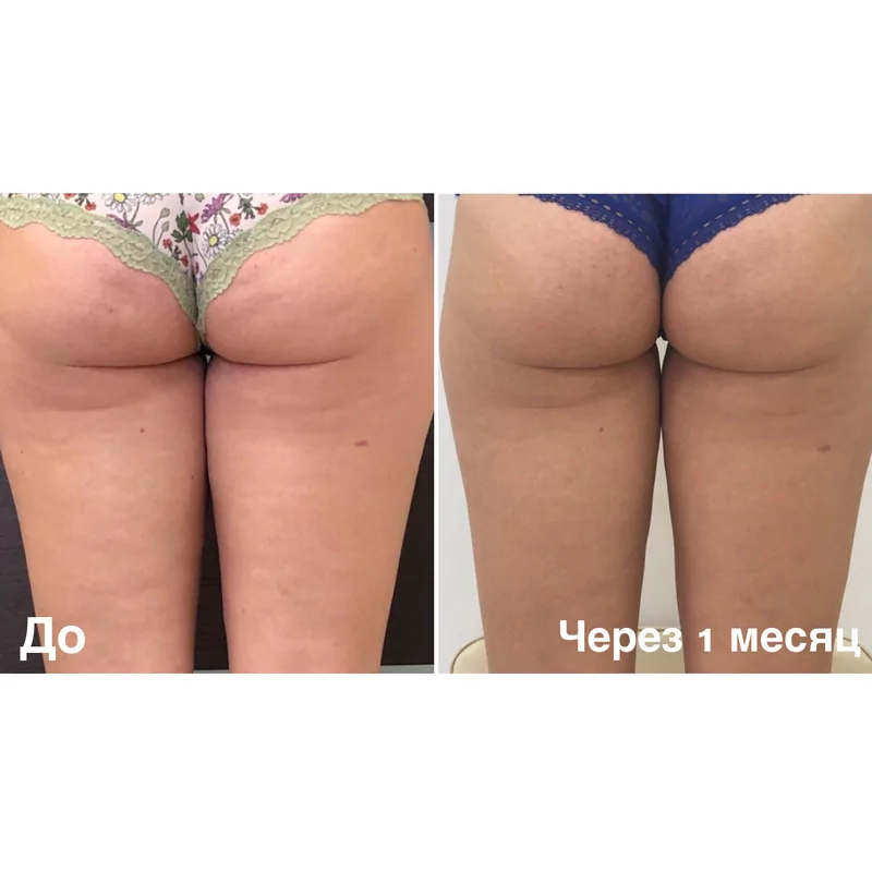 Фотография до и после с проведенной УЛФИТ терапии в Волгограде в клинике Олимп