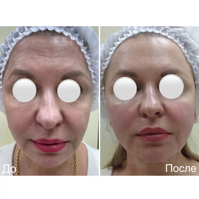 Фотография до и после с проведенной ютимс терапии в Волгограде в клинике Олимп