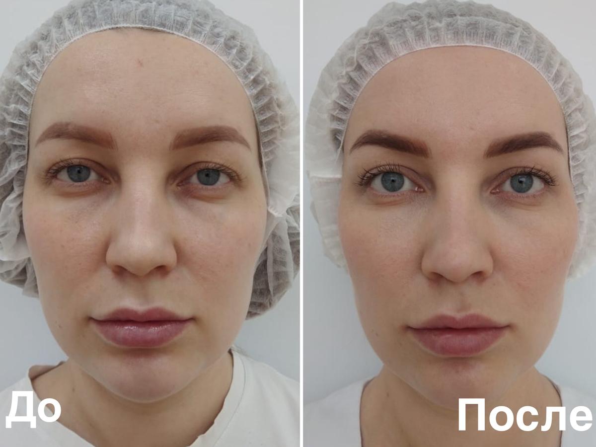 Фотография до и после альтера-терапии в Волгограде