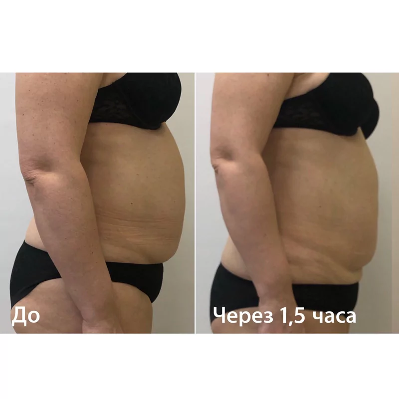 Фотография до и после с проведенной УЛФИТ терапии в Волгограде в клинике Олимп